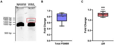 A novel PSMB8 isoform associated with multiple sclerosis lesions induces P-body formation